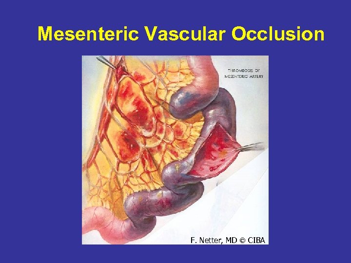 Mesenteric Vascular Occlusion F. Netter, MD CIBA 