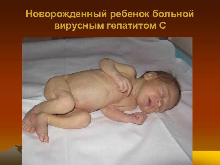 Новорожденный ребенок больной вирусным гепатитом С 