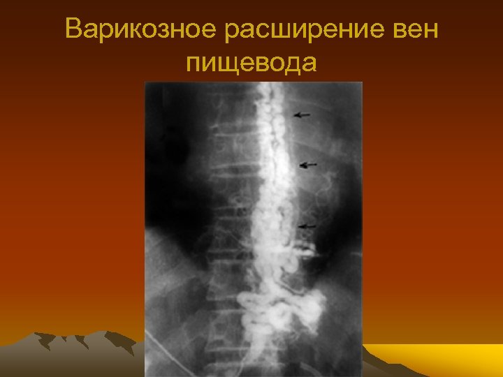 Варикозное расширение вен пищевода 