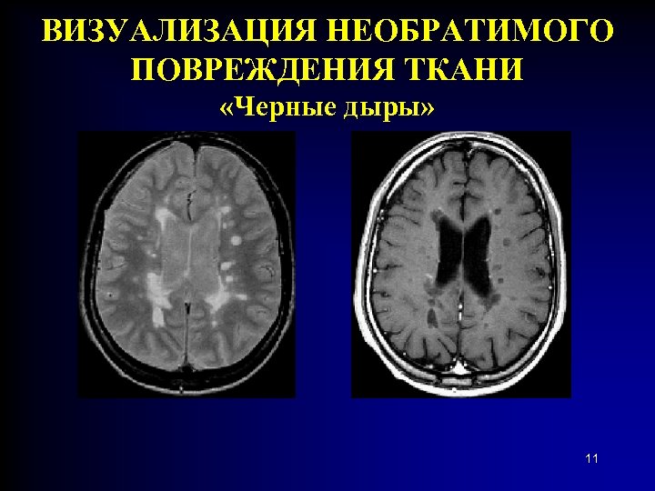 ВИЗУАЛИЗАЦИЯ НЕОБРАТИМОГО ПОВРЕЖДЕНИЯ ТКАНИ «Черные дыры» 11 