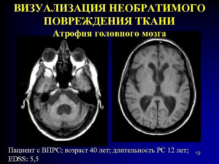 ВИЗУАЛИЗАЦИЯ НЕОБРАТИМОГО ПОВРЕЖДЕНИЯ ТКАНИ Атрофия головного мозга Пациент с ВПРС; возраст 40 лет; длительность