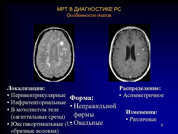 МРТ В ДИАГНОСТИКЕ РС Особенности очагов Локализация: Распределение: • Перивентрикулярные Форма: • Асимметричное •