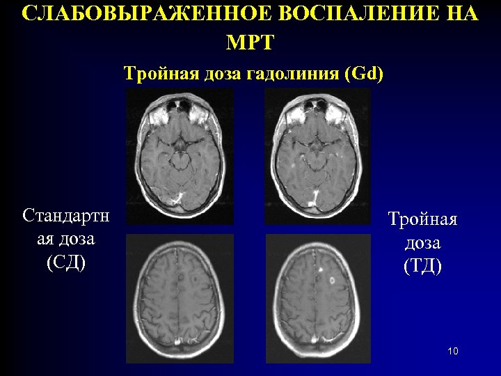 СЛАБОВЫРАЖЕННОЕ ВОСПАЛЕНИЕ НА МРТ Тройная доза гадолиния (Gd) Стандартн ая доза (СД) Тройная доза