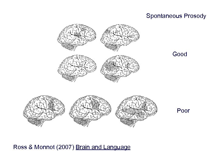 Spontaneous Prosody Good Poor Ross & Monnot (2007) Brain and Language 