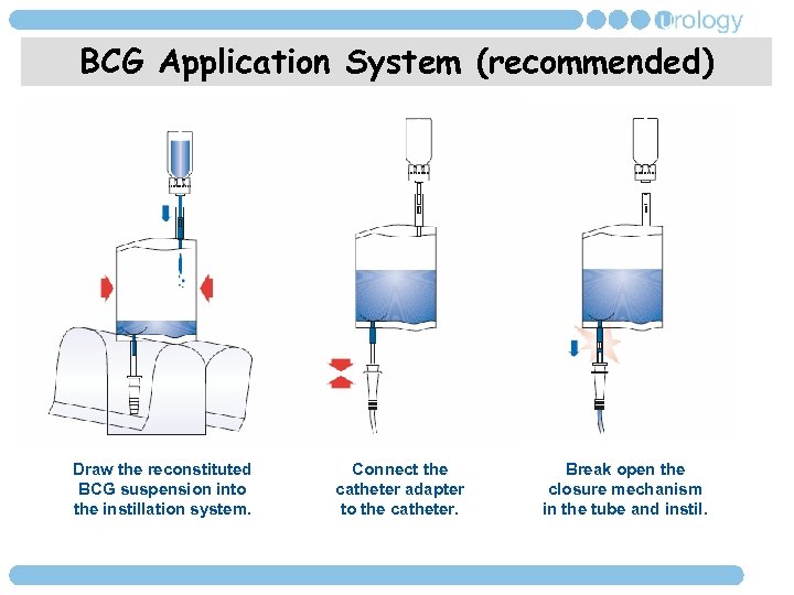 BCG Application System (recommended) Draw the reconstituted BCG suspension into the instillation system. Connect