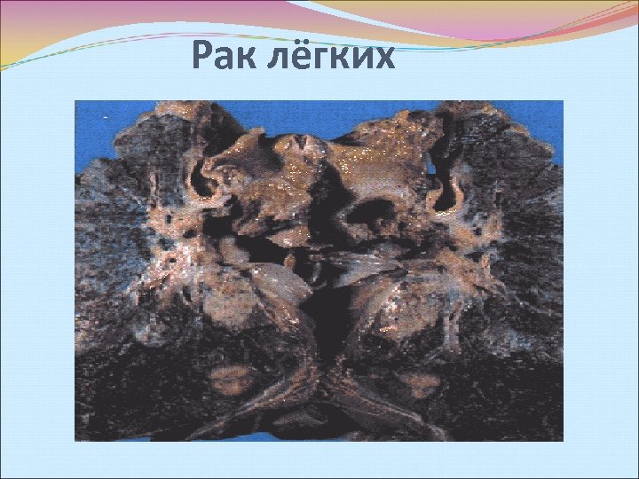 Рак лёгких 