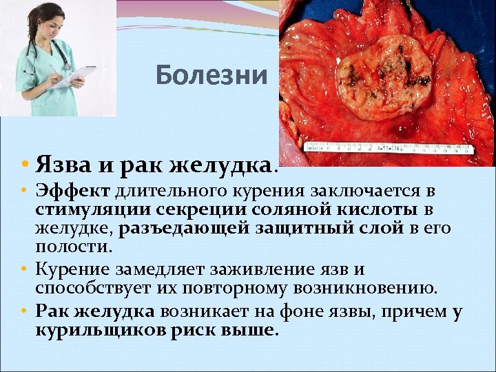 Болезни • Язва и рак желудка. • Эффект длительного курения заключается в стимуляции секреции