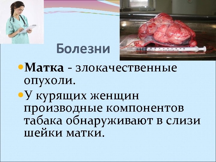 Болезни Матка - злокачественные опухоли. У курящих женщин производные компонентов табака обнаруживают в слизи