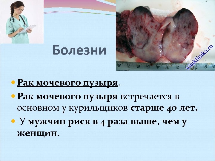 Болезни Рак мочевого пузыря встречается в основном у курильщиков старше 40 лет. У мужчин
