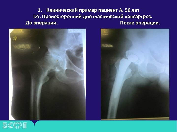 Коксартроз 3 степени инвалидность