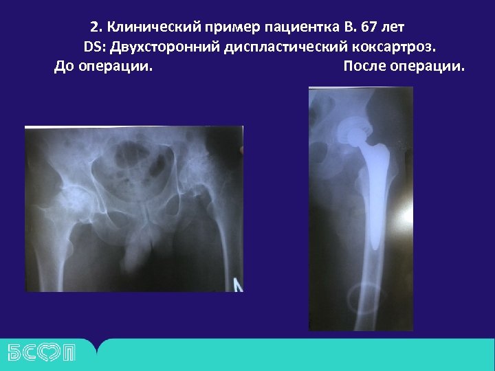 2. Клинический пример пациентка В. 67 лет DS: Двухсторонний диспластический коксартроз. До операции. После