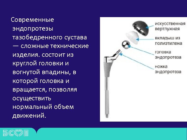 Современные эндопротезы тазобедренного сустава — сложные технические изделия. состоит из круглой головки и вогнутой