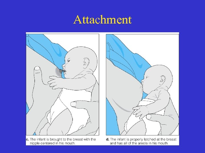 Attachment 