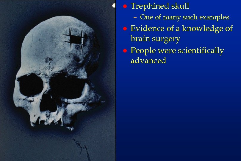 em 35 l Trephined skull – One of many such examples l l Evidence
