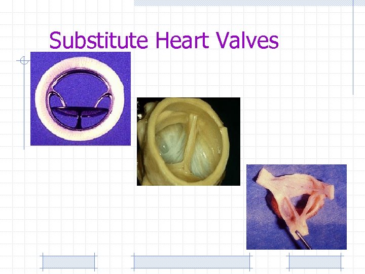 Substitute Heart Valves 