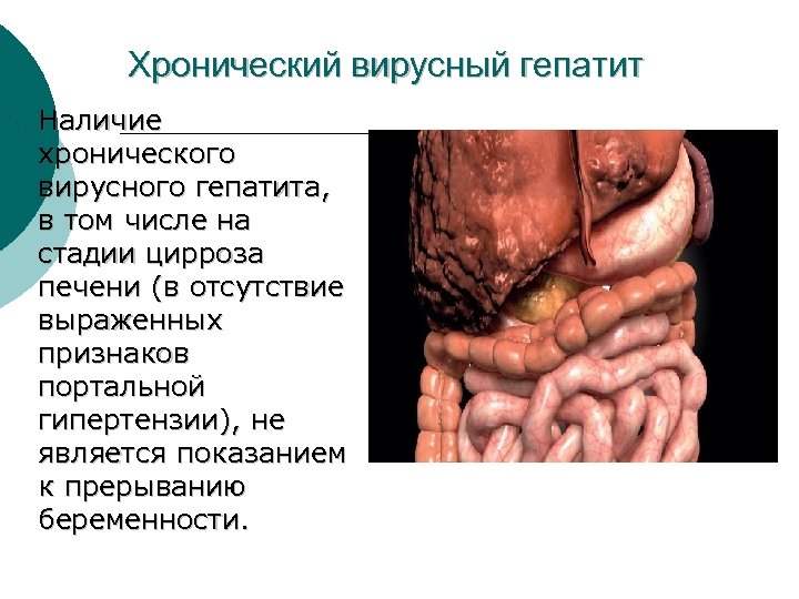 Хронический вирусный гепатит ¡ Наличие хронического вирусного гепатита, в том числе на стадии цирроза