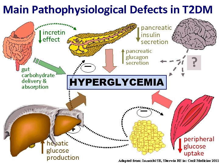 Main Pathophysiological Defects in T 2 DM pancreatic insulin secretion incretin effect - gut