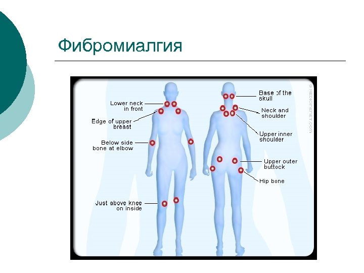 Фибромиалгия 