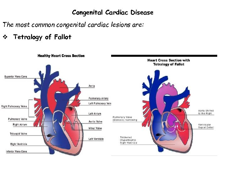 Congenital Cardiac Disease The most common congenital cardiac lesions are: v Tetralogy of Fallot
