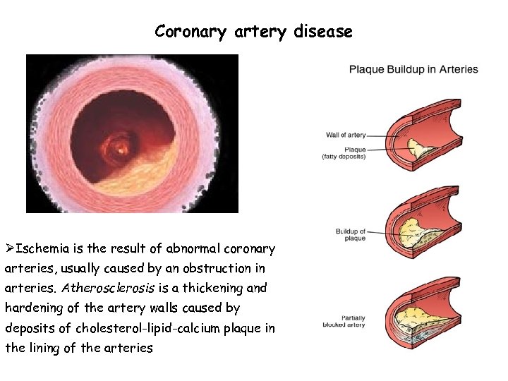 Coronary artery disease ØIschemia is the result of abnormal coronary arteries, usually caused by