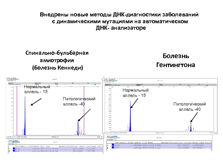 Внедрены новые методы ДНК-диагностики заболеваний с динамическими мутациями на автоматическом ДНК- анализаторе Спинально-бульбарная амиотрофия