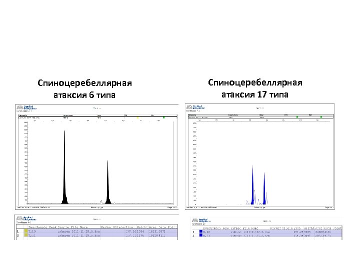 Спиноцеребеллярная атаксия 6 типа Спиноцеребеллярная атаксия 17 типа 