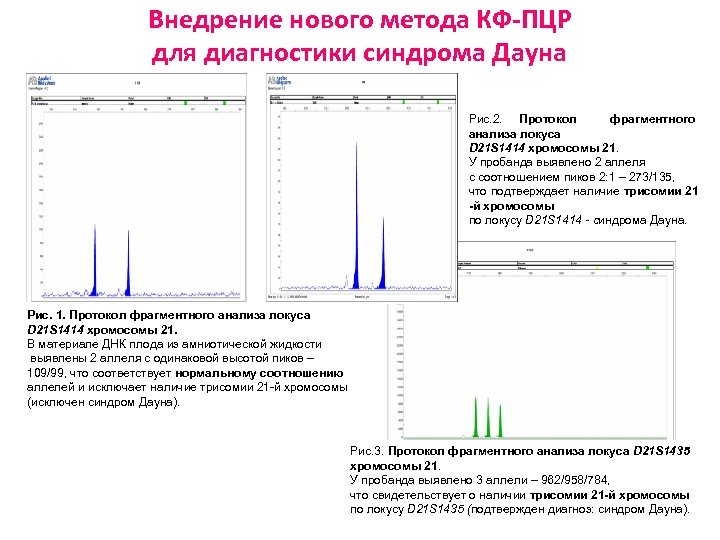 Внедрение нового метода КФ-ПЦР для диагностики синдрома Дауна Рис. 2. Протокол фрагментного анализа локуса