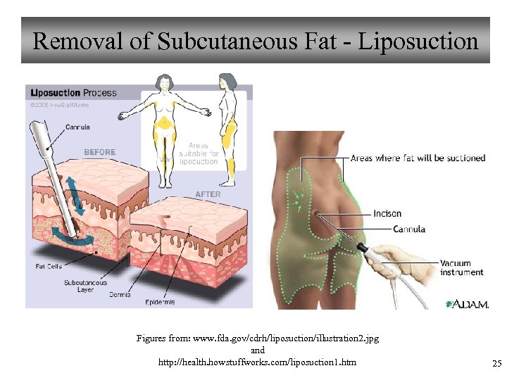 Removal of Subcutaneous Fat - Liposuction Figures from: www. fda. gov/cdrh/liposuction/illustration 2. jpg and