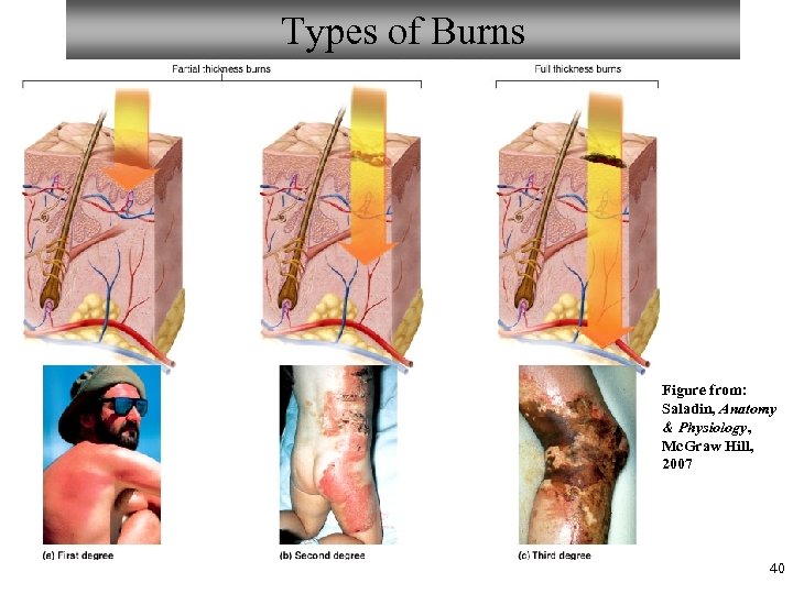 Types of Burns Figure from: Saladin, Anatomy & Physiology, Mc. Graw Hill, 2007 40