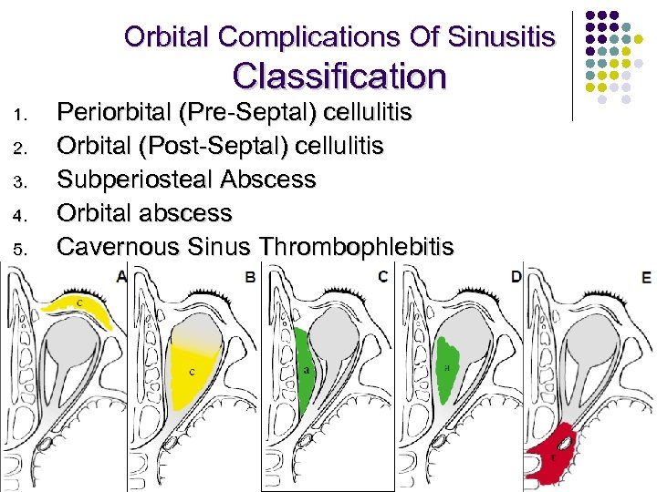 Orbital Complications Of Sinusitis Classification 1. 2. 3. 4. 5. Periorbital (Pre-Septal) cellulitis Orbital