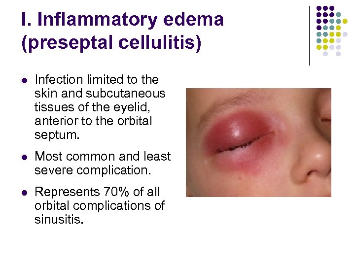 I. Inflammatory edema (preseptal cellulitis) l Infection limited to the skin and subcutaneous tissues