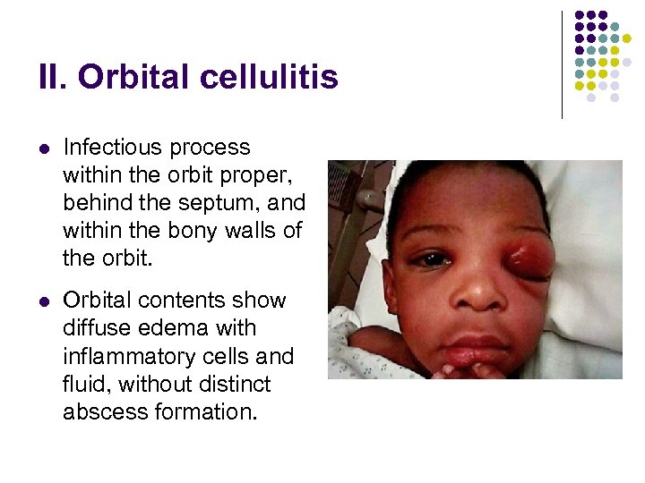 II. Orbital cellulitis l Infectious process within the orbit proper, behind the septum, and