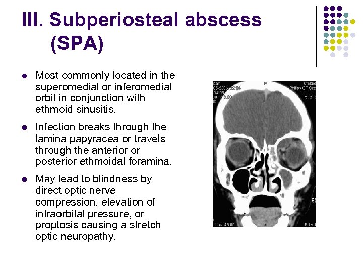 III. Subperiosteal abscess (SPA) l Most commonly located in the superomedial or inferomedial orbit