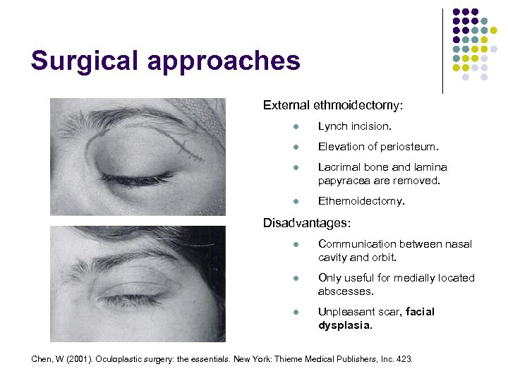 Surgical approaches External ethmoidectomy: l Lynch incision. l Elevation of periosteum. l Lacrimal bone