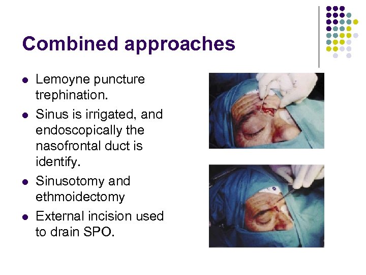 Combined approaches l l Lemoyne puncture trephination. Sinus is irrigated, and endoscopically the nasofrontal