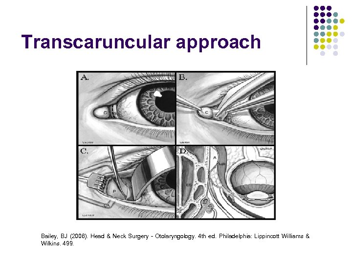 Transcaruncular approach Bailey, BJ (2006). Head & Neck Surgery - Otolaryngology. 4 th ed.