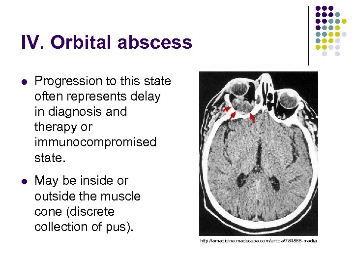 IV. Orbital abscess l Progression to this state often represents delay in diagnosis and