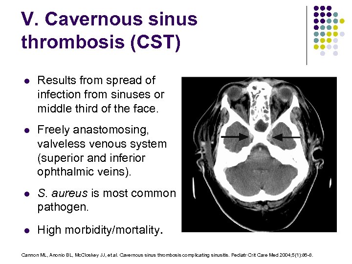 V. Cavernous sinus thrombosis (CST) l Results from spread of infection from sinuses or