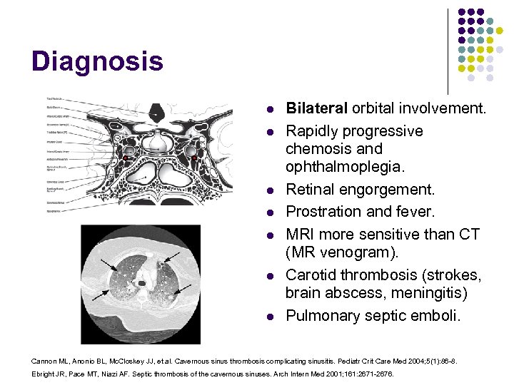 Diagnosis l l l l Bilateral orbital involvement. Rapidly progressive chemosis and ophthalmoplegia. Retinal