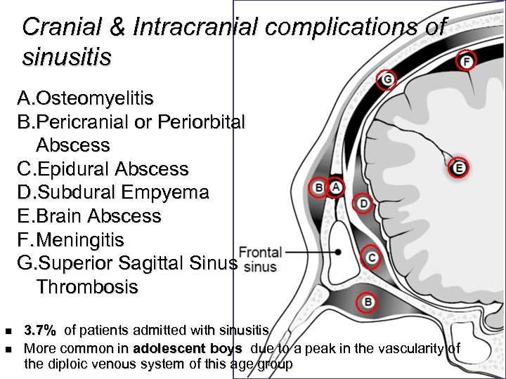 Cranial & Intracranial complications of sinusitis A. Osteomyelitis B. Pericranial or Periorbital Abscess C.