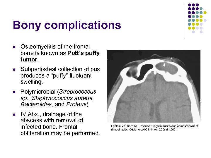 Bony complications l Osteomyelitis of the frontal bone is known as Pott’s puffy tumor.