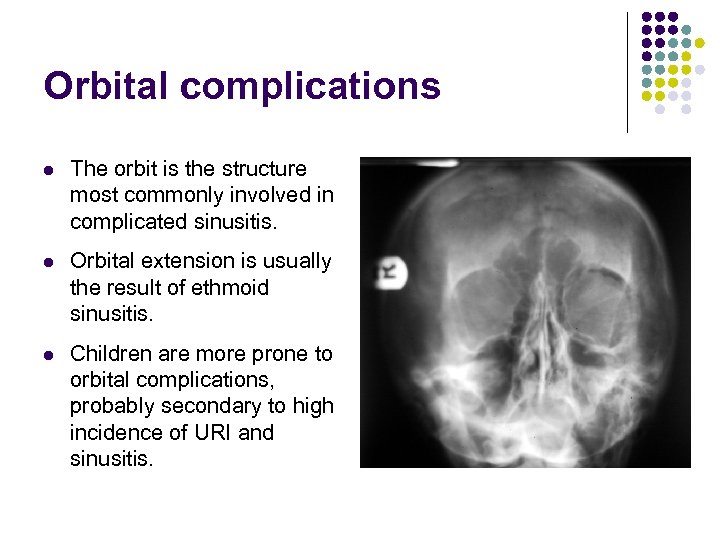 Orbital complications l The orbit is the structure most commonly involved in complicated sinusitis.