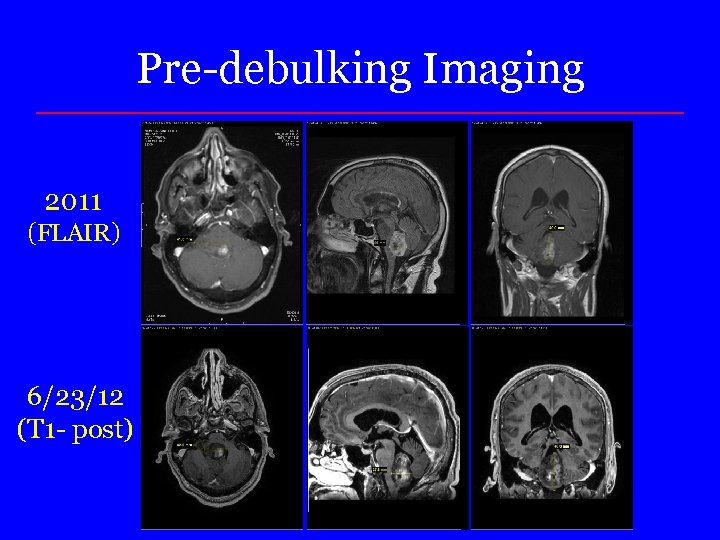 Pre-debulking Imaging 2011 (FLAIR) 6/23/12 (T 1 - post) 