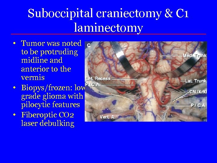 Suboccipital craniectomy & C 1 laminectomy • Tumor was noted to be protruding midline