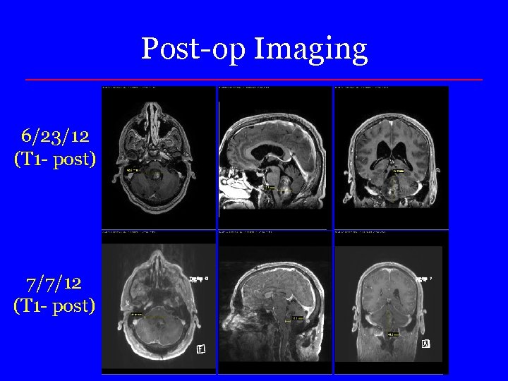 Post-op Imaging 6/23/12 (T 1 - post) 7/7/12 (T 1 - post) 