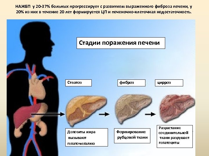 НАЖБП у 20 -37% больных прогрессирует с развитием выраженного фиброза печени, у 20% из