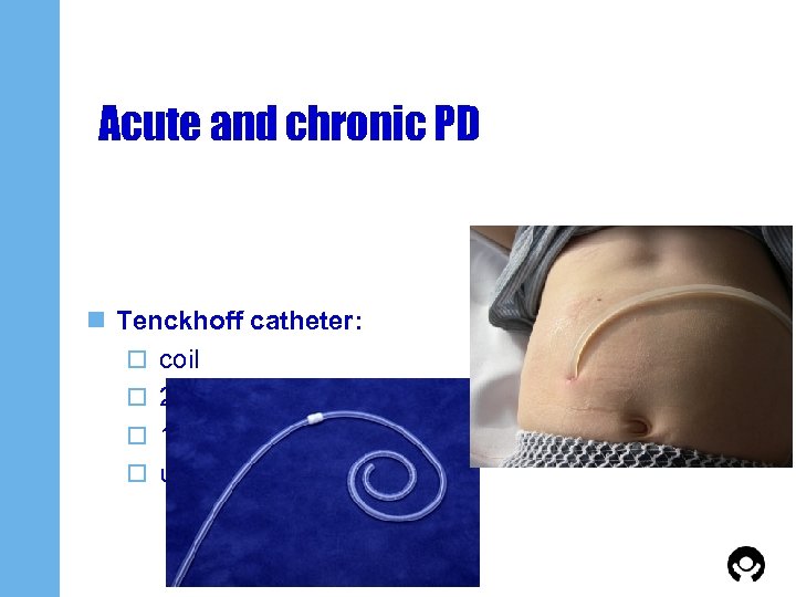 Acute and chronic PD n Tenckhoff catheter: o coil o 2 sizes: < /