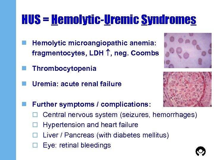 HUS = Hemolytic-Uremic Syndromes n Hemolytic microangiopathic anemia: fragmentocytes, LDH , neg. Coombs n