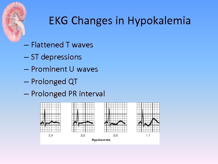 EKG Changes in Hypokalemia – Flattened T waves – ST depressions – Prominent U