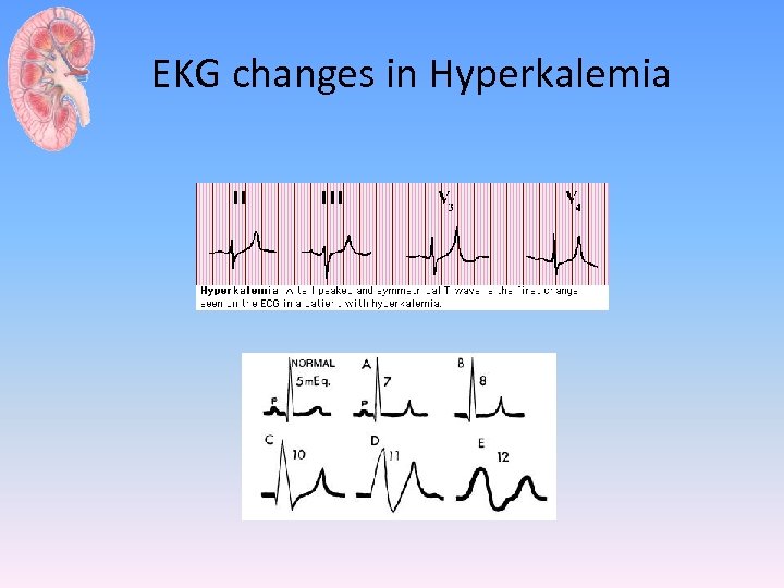 EKG changes in Hyperkalemia 